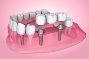 Dental Implants In Uptown Charlotte