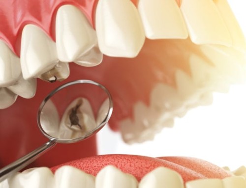 Common Causes for Cavities and Severe Tooth Decay