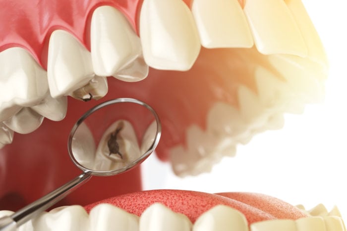 Cavities and Severe Tooth Decay