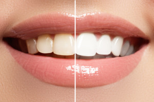 teeth whitening in charlotte