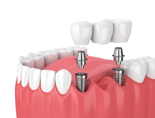 Facts and Myths About Dental Bridges