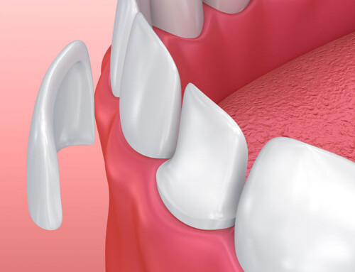 Dental Veneers: The Cost & The Facts