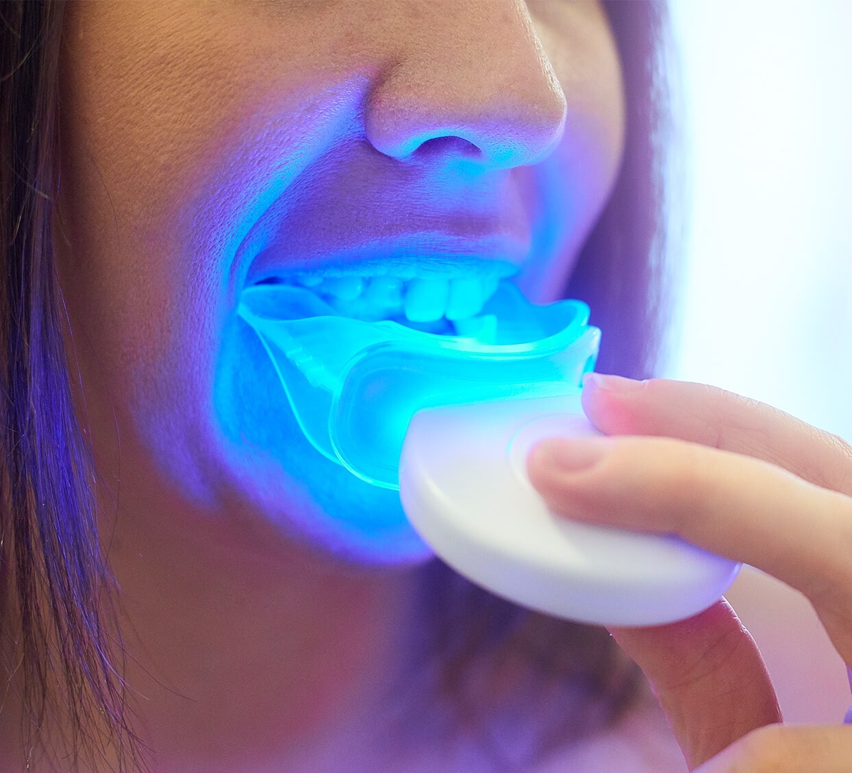 3 Reasons To Buy Teeth Whitening Kits - District Dentistry Charlotte