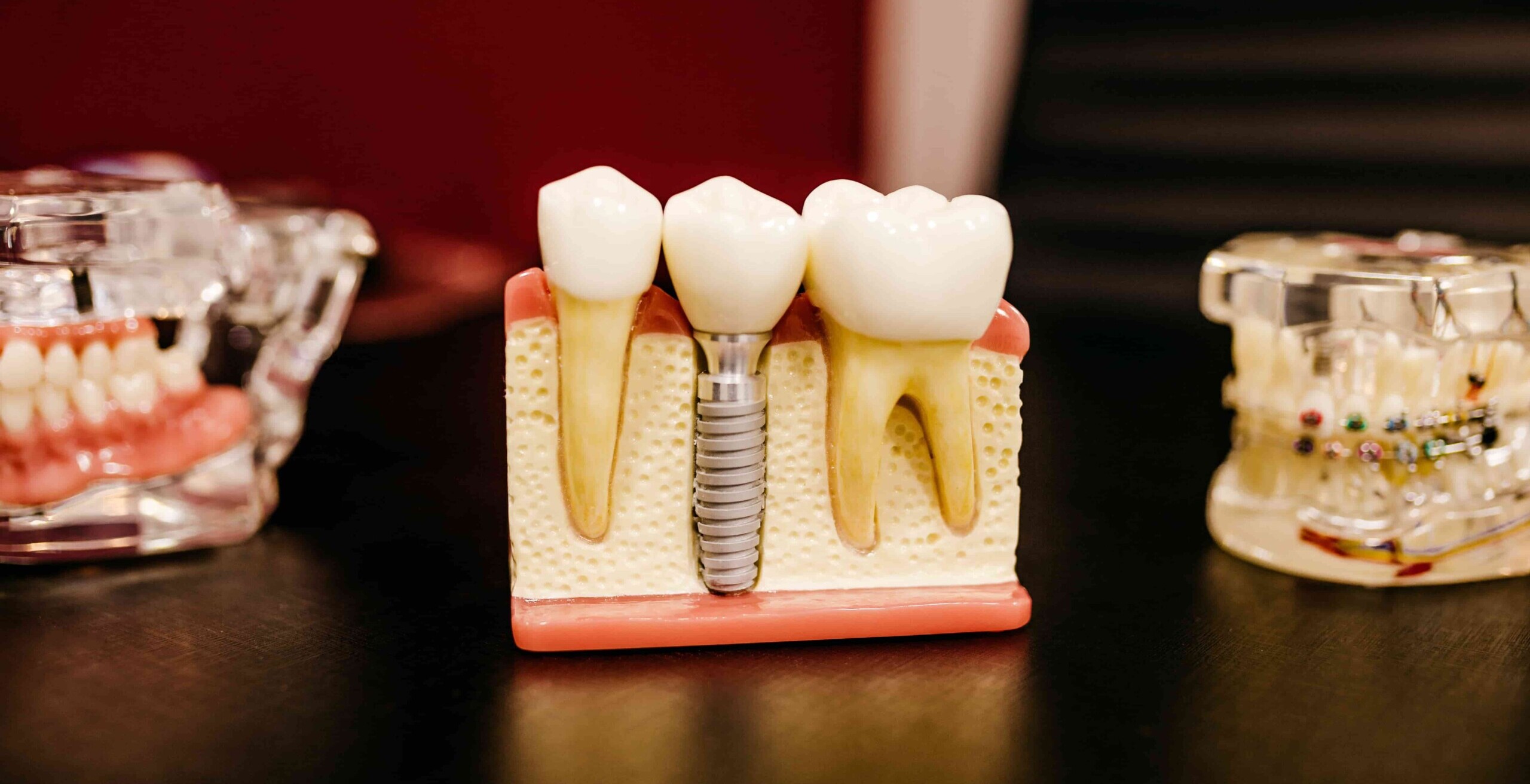 6 Adverse Effects of Dental Implants - District Dentistry