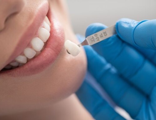 6 Side Effects of Dental Veneer Placement!