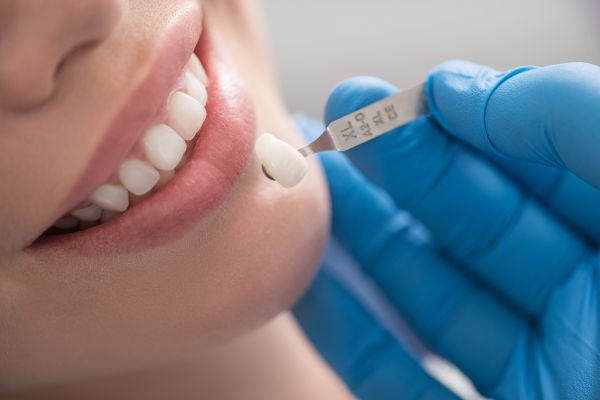6 Side Effects of Dental Veneer Placement - District Dentistry Charlotte