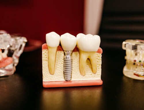 6 Important Tips To Keep Your Dental Implants In Top Shape