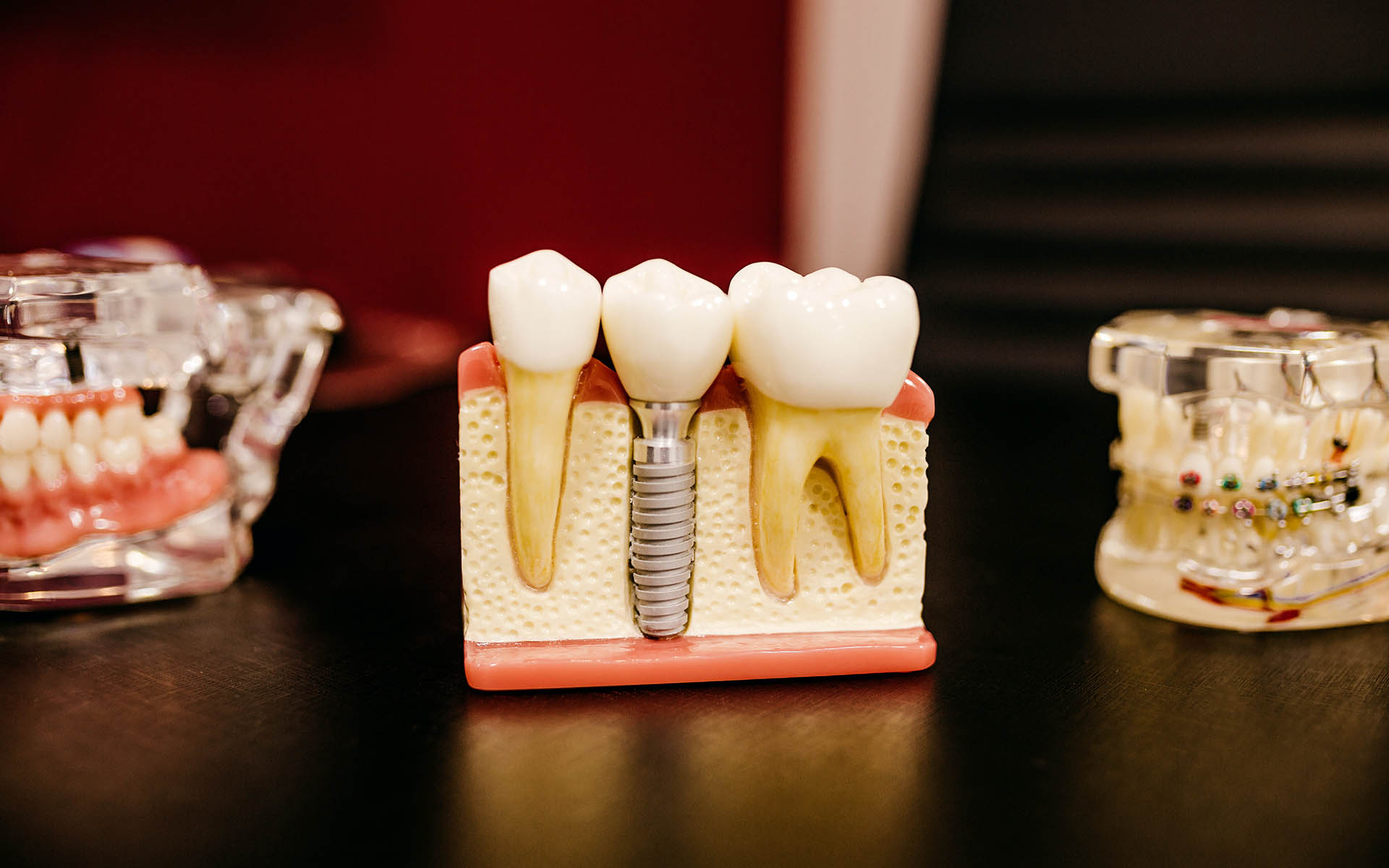 6 Important Tips To Keep Your Dental Implants In Top Shape - District Dentistry