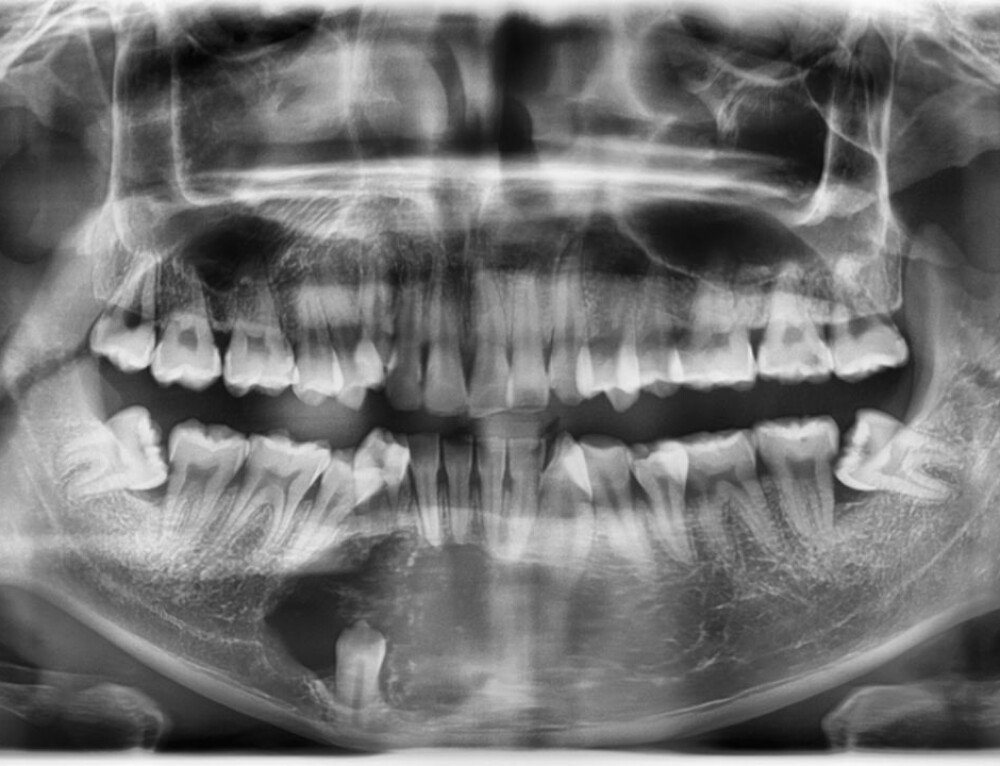 Dry Socket Alveolar Osteitis Explained District Dentistry Charlotte