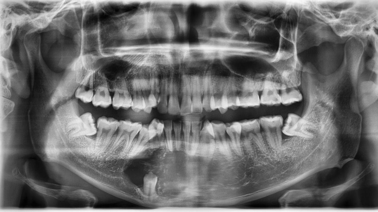 Dentigerous Cyst - What Is It - District Dentistry