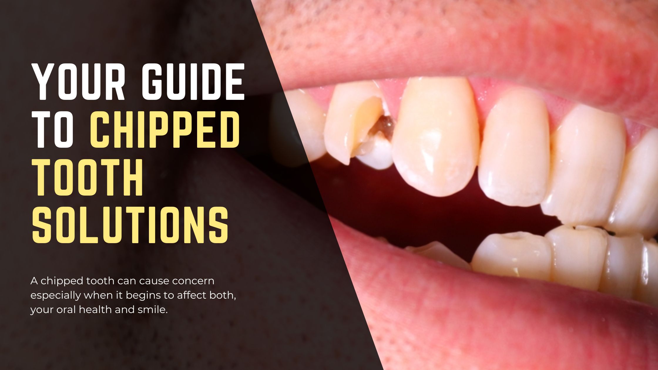Your Guide to Chipped Tooth Solutions - District Dentistry Charlotte