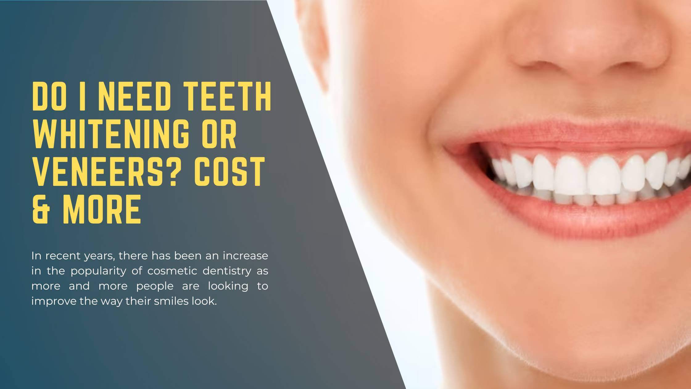 Do I Need Teeth Whitening Or Veneers - Cost and More - District Dentistry Charlotte