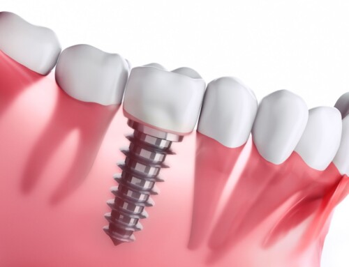 5 Compelling Reasons to Choose Dental Implants for a Radiant Smile Makeover
